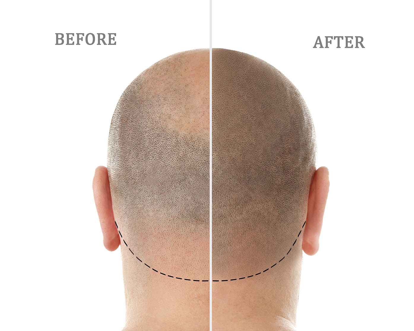 Hair Transplantation