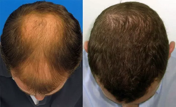 Hair transplant fue method turkey go2 hair